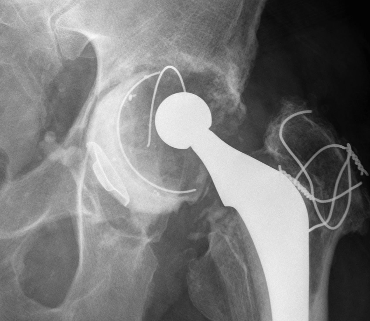 Revision Acetabulum Type IIC